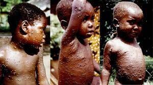 BREAKING NEWS:- US President "Joe Biden" test positive to COVID-19, World Health Organization Declares Monkeypox Global Health Emergency, INFINITY LOADED