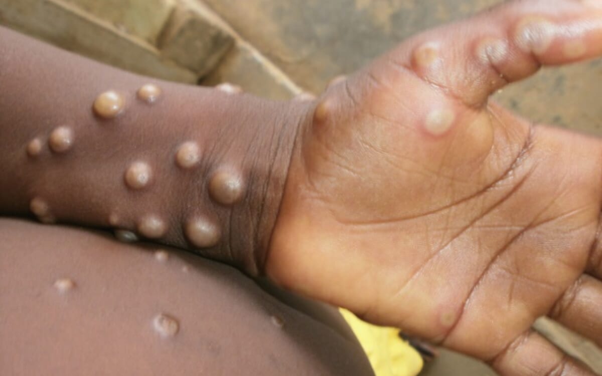 NCDC Confirms Four Deaths and 157 Monkeypox cases,, INFINITY LOADED NCDC Confirms Four Deaths and 157 Monkeypox cases,, NCDC Confirms Four Deaths and 157 Monkeypox cases,, INFINITY LOADED