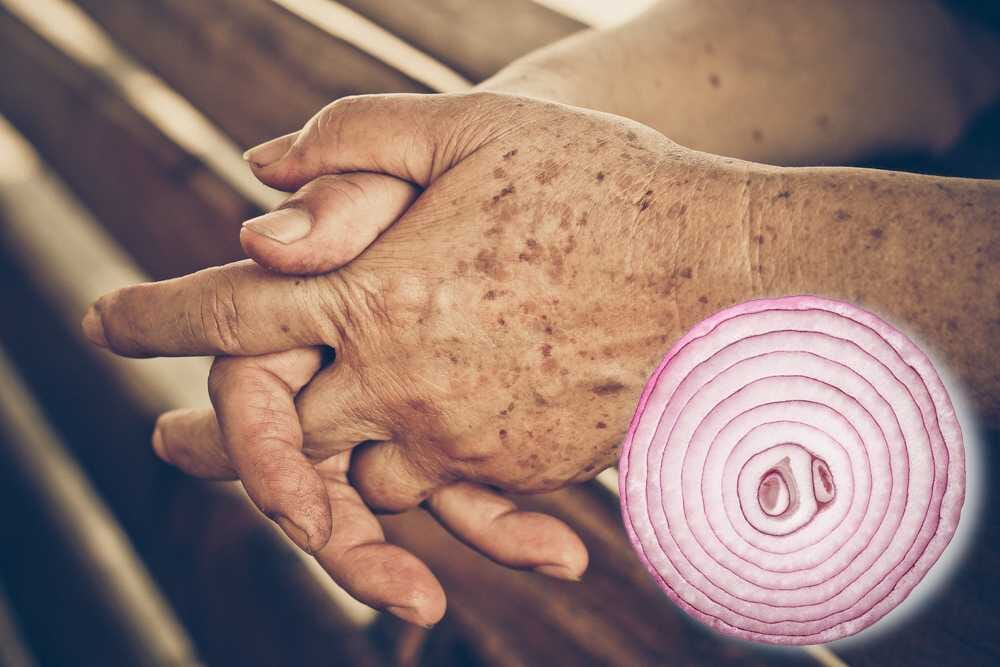 Do you have Age Spots On Your Skin? This Simple Trick Can Help You Reduce Them In No Distant Time!, Do you have Age Spots On Your Skin? This Simple Trick Can Help You Reduce Them In No Distant Time!, INFINITY LOADED